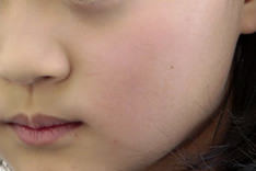 おたふくかぜ（流行性耳下腺炎）